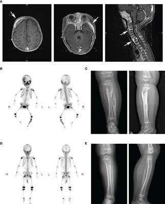 A novel STAT1 loss-of-function mutation associated with Mendelian susceptibility to mycobacterial disease